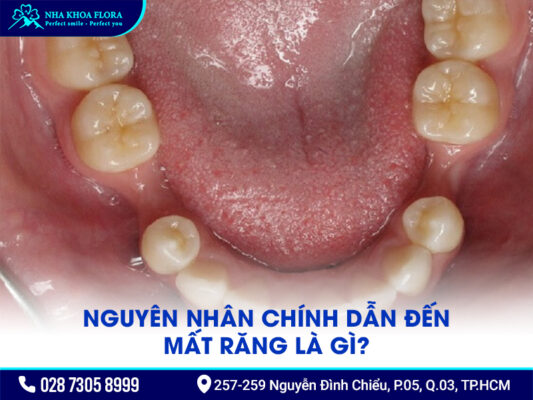 Nguyên nhân chính dẫn đến mất răng