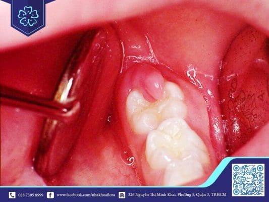 Răng khôn xuất hiện dễ gây ra tình trạng viêm nướu (ảnh minh họa)