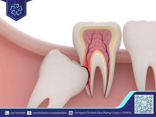 Răng số 8 mọc lệch (ảnh minh họa)