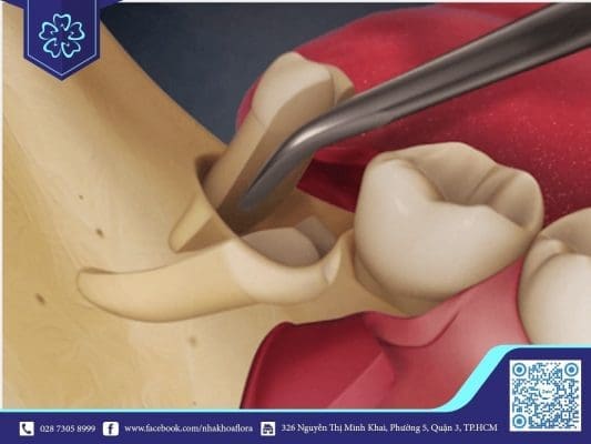 Nhổ răng số 8 (ảnh minh họa)