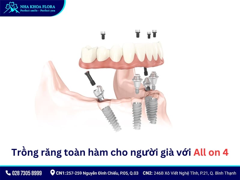 trồng răng toàn hàm cho người già với all on 4
