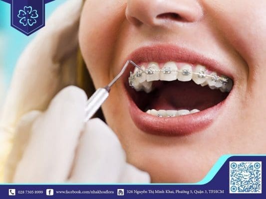 NIỀNG RĂNG THẨM MỸ GIÁ BAO NHIÊU? NÊN CHỌN CÁCH NIỀNG RĂNG NÀO? 1