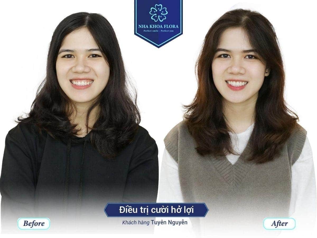 Chữa thành công cười lộ nướu