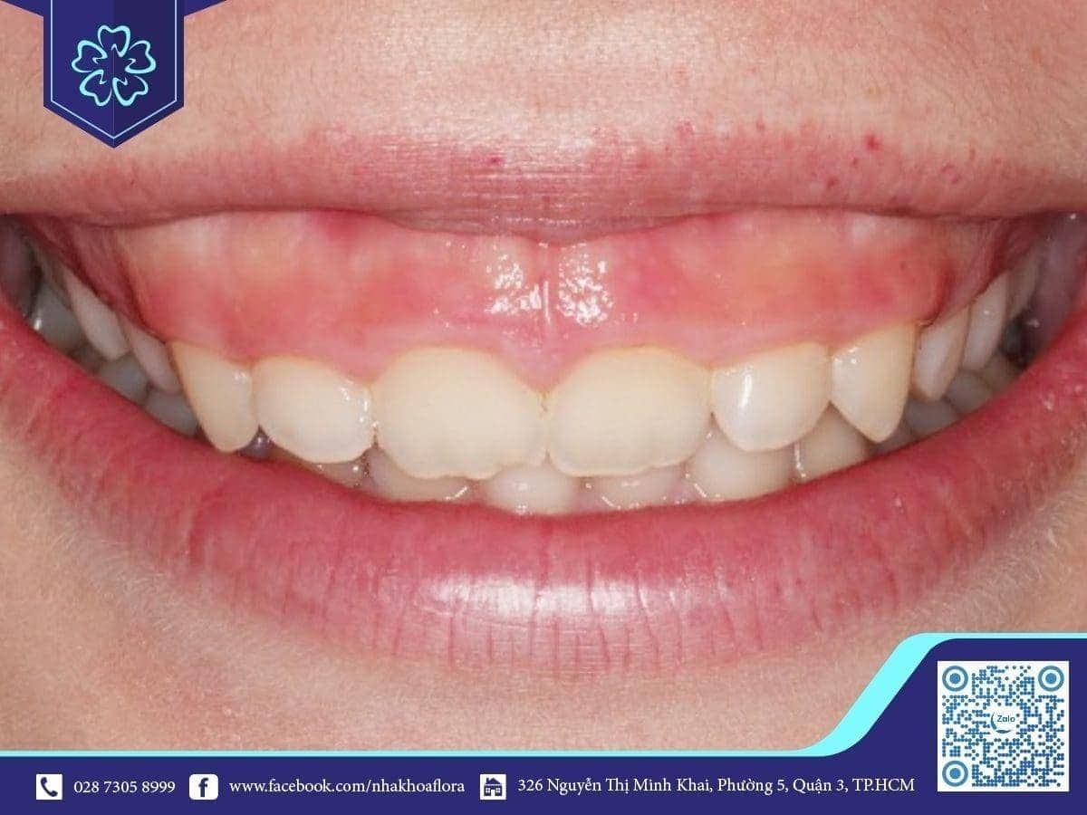 Điều trị cười lộ nướu để cải thiện cuộc sống