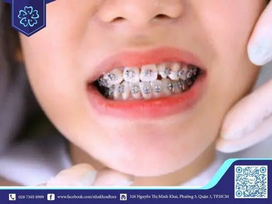 CÁC BIẾN CHỨNG THƯỜNG GẶP KHI NIỀNG RĂNG KÉM CHẤT LƯỢNG. 1