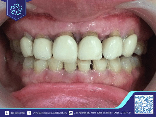 Bọc răng sứ kém chất lượng ảnh hưởng thẩm mỹ và chất lượng răng (ảnh minh họa)