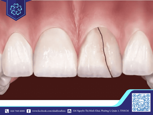 Răng sứ kém chất lượng dễ vỡ, nứt (ảnh minh họa)