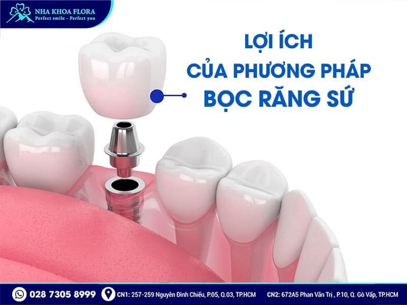 Bọc răng sứ có bền không? - Ảnh 1