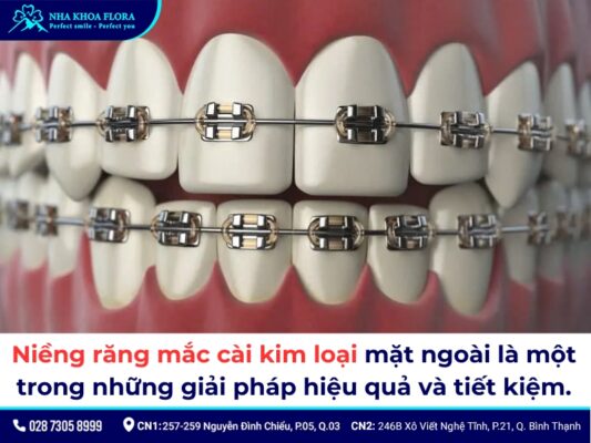 Các loại niềng răng - ảnh 1