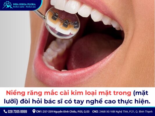 Các loại niềng răng - ảnh 3