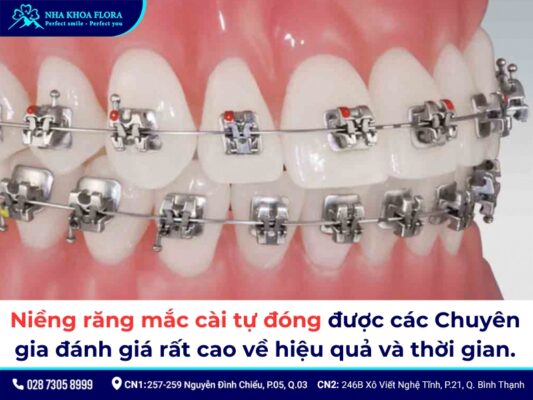 Các loại niềng răng - ảnh 4