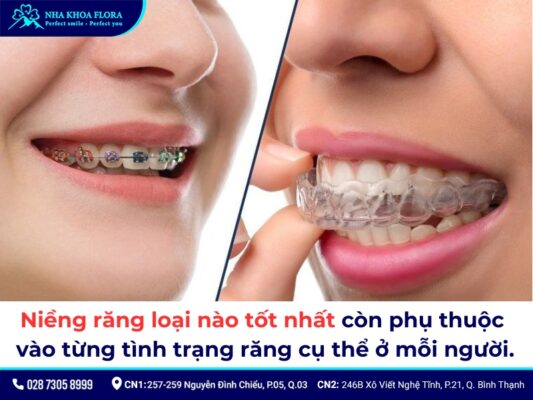 Các loại niềng răng - ảnh 6