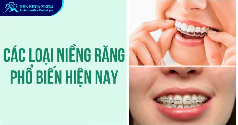 Các loại niềng răng