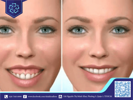 Biến chứng điều trị cười hở lợi