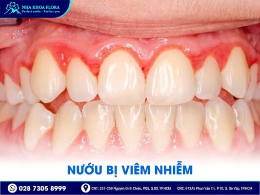 biến chứng sau phẫu thuật hở lợi - ảnh 1