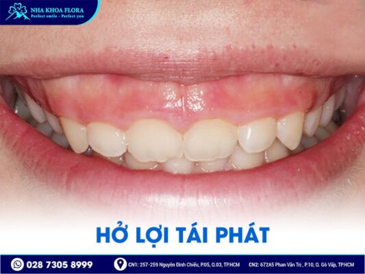 biến chứng sau phẫu thuật hở lợi - ảnh 4