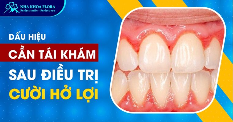 biến chứng cười hở lợi