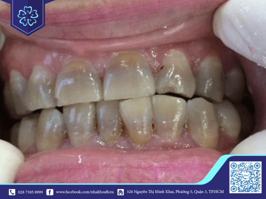 Răng bị nhiễm màu nên bọc răng sứ