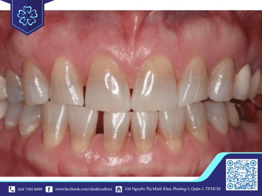 [ƯU ĐÃI] Chi phí bọc 2 hàm răng toàn sứ giá bao nhiêu | Nha khoa Flora 1