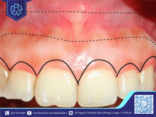 TƯ VẤN ONLINE CHỮA CƯỜI HỞ LỢI CÙNG NHA KHOA FLORA 2
