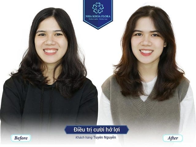Khách hàng chữa cười hở lợi thành công tại nha khoa Flora