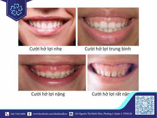Các mức độ cười hở lợi (ảnh minh họa)