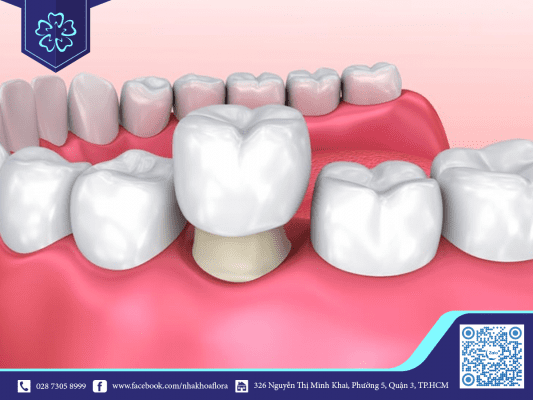 Quá trình bọc răng sứ có nguy hiểm như bạn nghĩ? 2