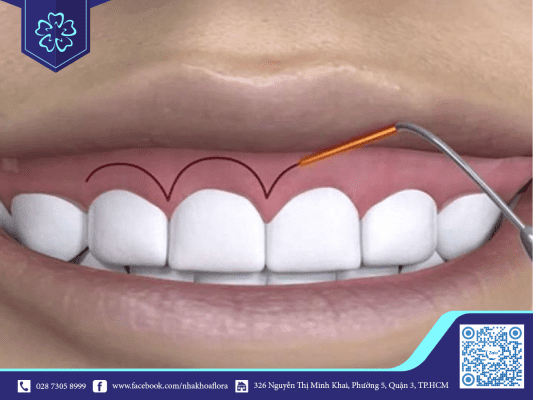 DISTINGUISHING OPEN-EYED SURGERY FROM JAWS 5