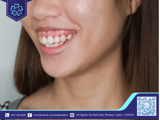 Điều trị cười hở lợi