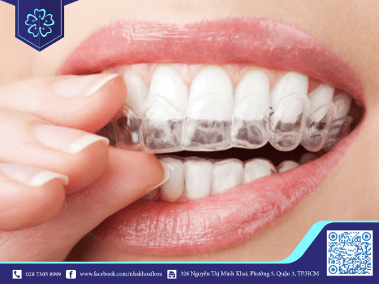 Niềng răng trong suốt hiệu quả với trường hợp nghiến răng