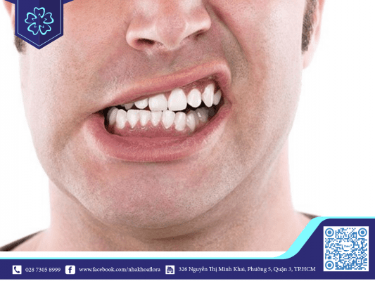 Nghiến răng có thể gây ảnh hưởng hiệu quả niềng răng