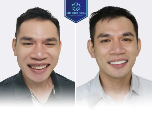 biến chứng cười hở lợi - ảnh 6