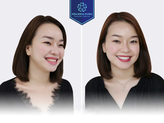 biến chứng cười hở lợi - ảnh 7