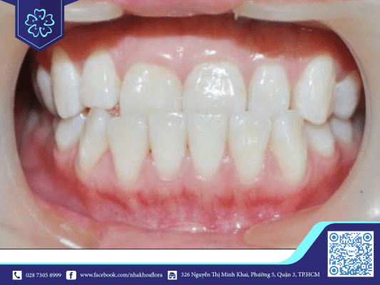 lech-khop-can-do-rang Lệch khớp cắn do răng