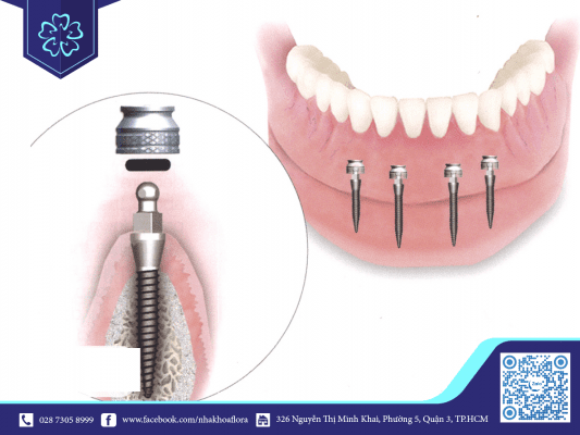 Cấy ghép bằng trụ Implant có kích thước nhỏ