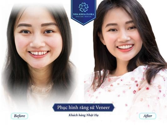 Trang thiết bị hiện đại cho công nghệ bọc răng sứ 2021 1