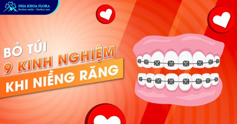 chia sẻ kinh nghiệm niềng răng