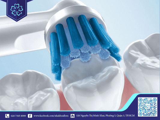 Lưu ý khi niềng răng invisalign 1