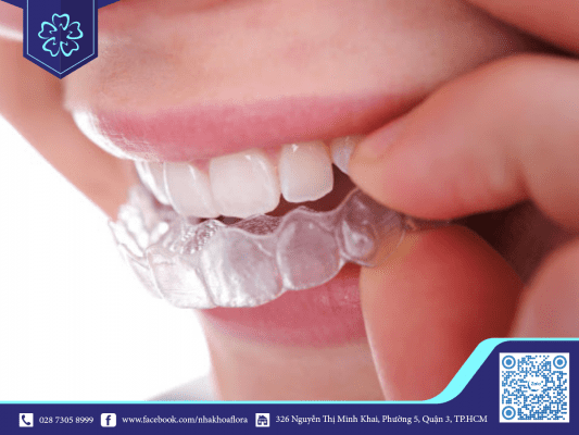 Lưu ý niềng răng trong suốt giúp đảm bảo kết quả điều trị (ảnh minh họa)