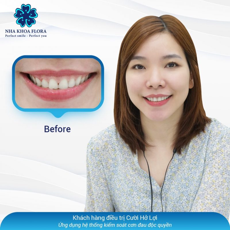 Khách hàng chữa cười hở lợi bằng hệ thống kiểm soát cơn đau tại nha khoa Flora