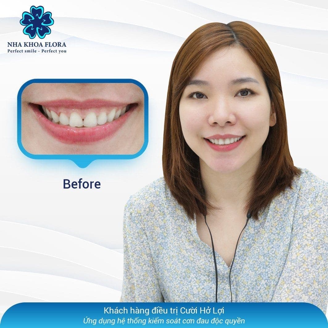 Khách hàng phẫu thuật cắt nướu răng tại Nha Khoa Flora