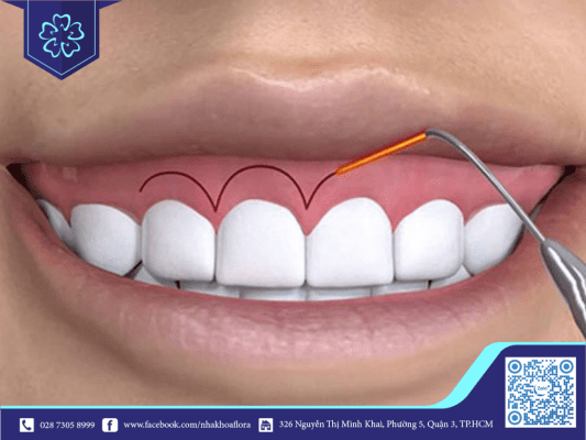 Kỹ thuật phẫu thuật cười hở lợi an toàn và hiệu quả phổ biến hiện nay 1