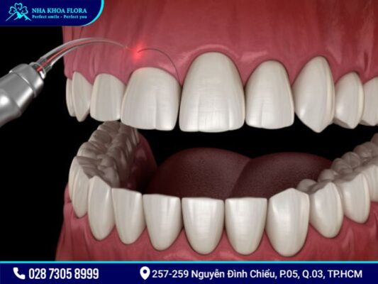 phẫu thuật cười hở lợi mất bao lâu - ảnh 2