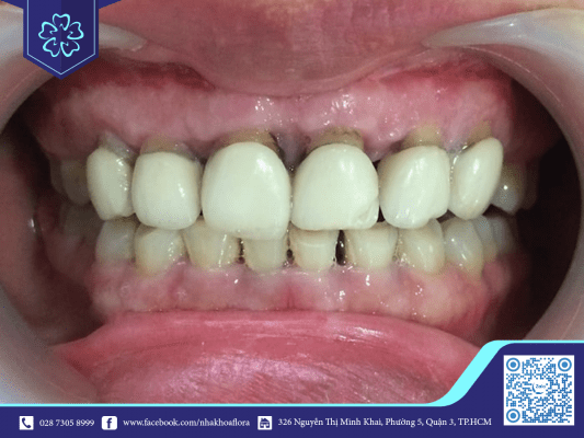 Tác hại bọc răng sứ sai cách (ảnh minh họa)