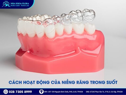 quá trình niềng răng trong suốt - ảnh 1