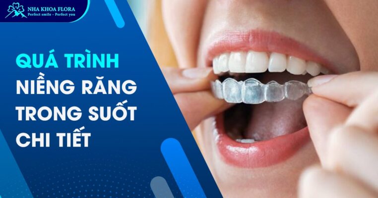 quá trình niềng răng trong suốt