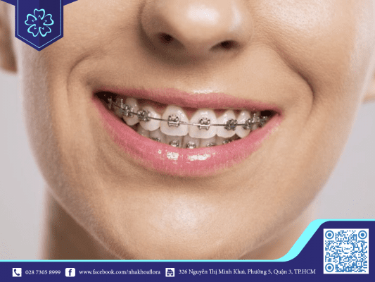 Quy trình niềng răng ổn định phụ thuộc vào xương hàm (ảnh minh họa)