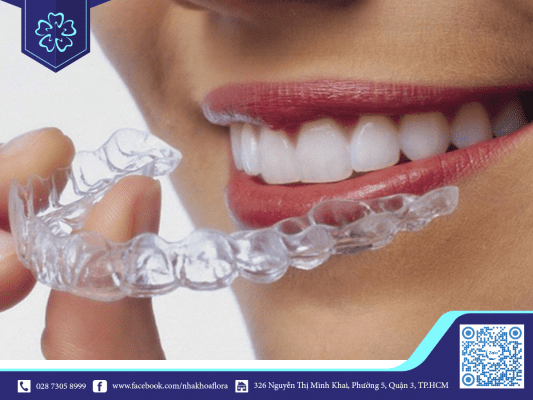 Thời gian niềng răng trong suốt phụ thuộc vào công nghệ niềng và mức độ lệch của răng miệng (ảnh minh họa)