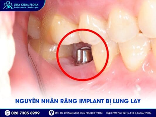 trụ implant bị lung lay - ảnh 1
