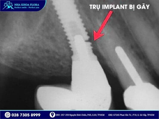 trụ implant bị lung lay - ảnh 2